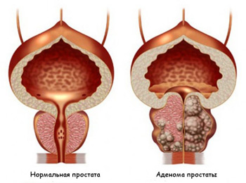 prostate adenoma