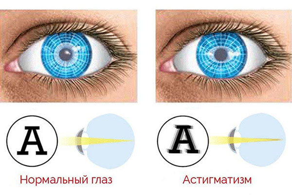 Амблиопия «ленивый глаз» - степени и лечение у взрослых и детей