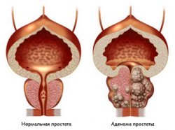 Diagnosis and treatment of prostate adenoma - clinic AVICENNA MED, Kiev