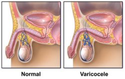 Diagnosis and treatment of varicocele - AVICENNA MED, Kiev