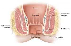 Anal fissure - AVICENNA MED, Kyiv