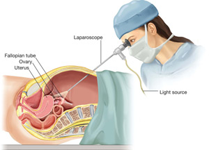 3D laparoscopy in gynecology - AVICENNA MED, Kiev
