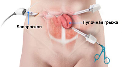 Лечение пупочной грыжи - АВИЦЕННА МЕД, Киев