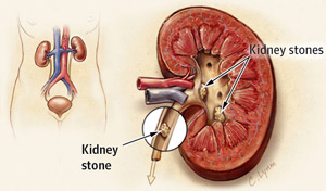Removal of kidney stones - AVICENNA MED, Kiev