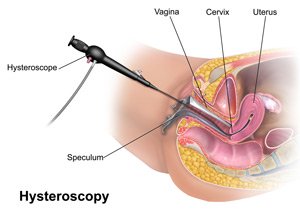 Hysteroscopy of the uterus. Diagnostics consultation AVICENNA