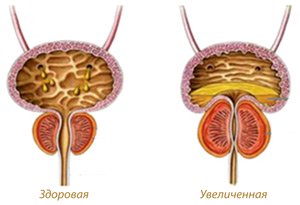 Treatment of prostate adenoma - AVICENNA MED, Kiev