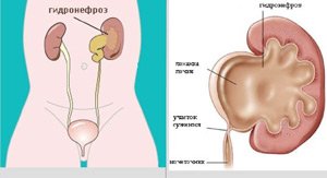 Diagnosis and treatment of hydronephrosis - AVICENNA MED, Kiev