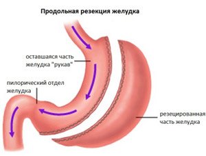 Продольная резекция желудка - клиника АВИЦЕННА МЕД, Киев