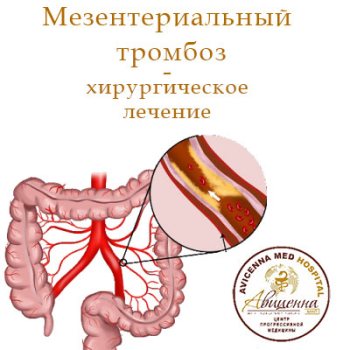 Хирургия мезентериального тромбоза - АВИЦЕННА МЕД, Киев
